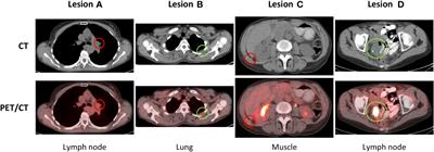 PET/CT radiomics for prediction of hyperprogression in metastatic melanoma patients treated with immune checkpoint inhibitors